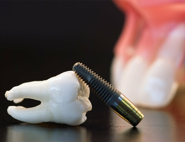  Implants dentaires à la clinique dentaire Revival