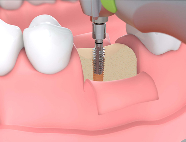  Greffe de la mâchoire à la clinique dentaire Revival – La solution idéale pour le soutien des implants dentaires