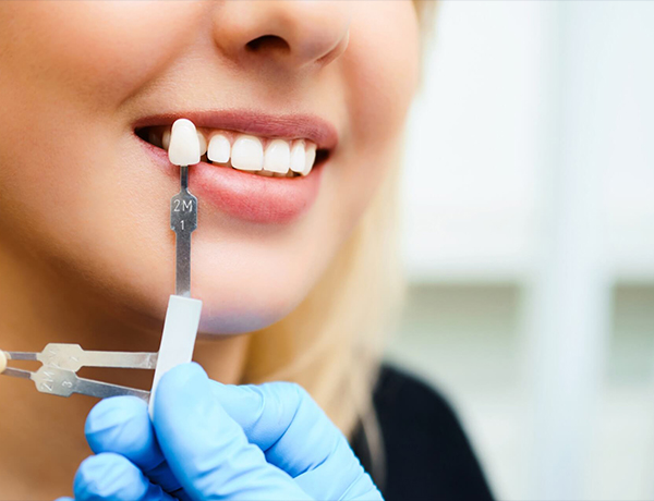  Facettes dentaires – Le secret d’un sourire parfait à la clinique dentaire Revival